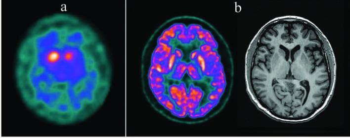 Multi-modal diagnostic imaging of the brain in the axial plane demonstrating findings consistent with neurodegenerative parkinsonism. Image (a) is a 123I-ioflupane DAT SPECT scan showing bilaterally decreased radiotracer uptake in the striatal structures of the basal ganglia, particularly affecting the putaminal regions, giving the remaining uptake an oval appearance. An asymmetric pattern is noted with a more pronounced deficit in the left basal ganglion. Image (b) presents a side-by-side comparison of an 18F-FDG PET scan and a T1-weighted MR image. The FDG-PET reveals relatively increased glucose metabolism in the bilateral putaminal regions, which serves as a metabolic marker for Parkinson's disease. The corresponding T1-weighted MRI shows normal anatomical structures without specific pathological changes or volume loss in the cerebral cortex. This comparison illustrates the clinical significance of functional imaging (SPECT and PET) over structural imaging (MRI) in the early diagnosis of dopamine transporter deficiency and metabolic shifts associated with Parkinsonian syndromes.