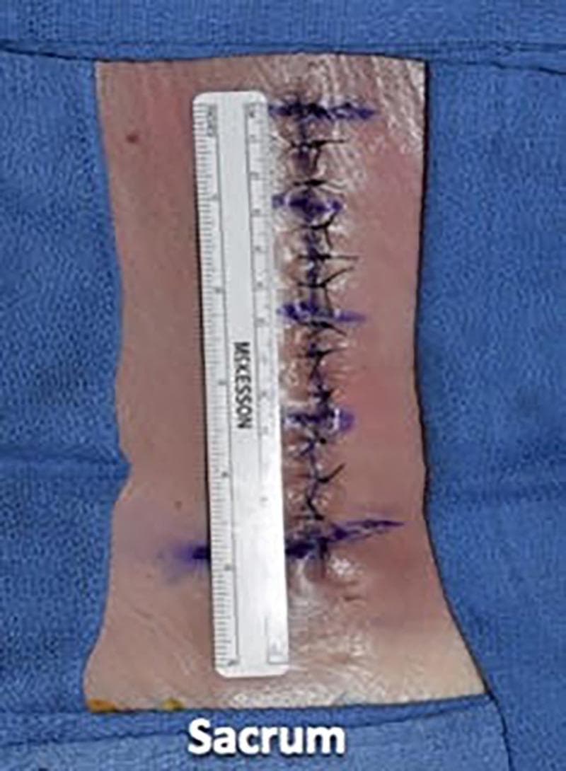 A clinical photograph demonstrating epidermal wound closure on a cadaveric specimen in the prone position, specifically targeting the lumbar region superior to the sacrum. The image shows a vertical midline incision that has been reapproximated using a simple interrupted suture technique. Dark-colored, monofilament sutures (likely 3-0 nylon) are placed at approximately 1-cm intervals, with visible square knots on the skin surface. Surgical marking pen traces are visible in violet adjacent to each suture site, indicating preoperative or intraoperative planning. A surgical ruler is placed vertically alongside the wound for scale, confirming the spacing and length of the closure. The surrounding skin is light-toned and flanked by blue sterile surgical drapes. The white text label 'Sacrum' at the bottom of the frame provides anatomical orientation. This visual serves as an educational tool for medical training in surgical suturing techniques, specifically demonstrating the final layer of a multi-layer closure following deeper facial and dermal reapproximation.