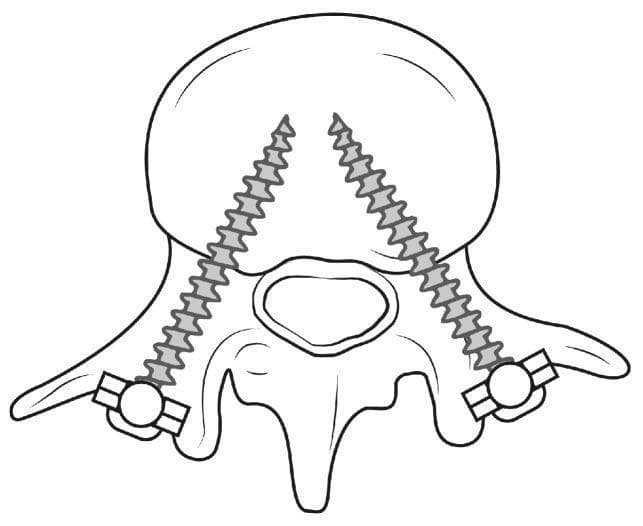 This schematic illustration depicts an anatomical diagram of a lumbar vertebra from a superior (axial) perspective, demonstrating bilateral pedicle screw placement (PSP). The diagram identifies key vertebral structures, including the large anterior vertebral body, the central vertebral foramen, bilateral pedicles, transverse processes, and the posterior spinous process. Two orthopedic screws are shown in situ, inserted through the pedicles on both the left and right sides. The trajectory of the screws is convergent, angling medially and anteriorly from the posterior entry points toward the center of the vertebral body to maximize purchase and stability. The screw heads are located posteriorly, featuring circular housings connected to short horizontal segments, representing the attachment points for longitudinal rods or plates used in spinal fusion procedures. This educational graphic serves to visualize the relationship between spinal instrumentation and vertebral anatomy, emphasizing the precise path required for safe and effective spinal stabilization.