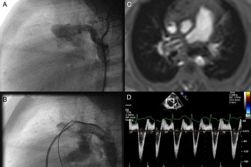 This composite figure illustrates advanced interventional and surgical management of pediatric pulmonary hypertension and heart failure through a four-panel multimodal display. Panels A and B are fluoroscopic angiograms showing a surgical reversed 'Potts' shunt (a connection between the descending aorta and the left pulmonary artery). Panel A demonstrates the initial 6mm PTFE shunt, while Panel B shows the same shunt dilated using an 8mm Formula stent, with a guidewire visible indicating the percutaneous procedure. Panel C is an MRI scan in the axial plane showing bilateral pulmonary artery banding, characterized by physical constrictions on both pulmonary arteries to balance circulation. Panel D presents a Doppler echocardiography trace with a spectral display demonstrating bidirectional flow dynamics: a systolic right-to-left shunt and a diastolic left-to-right shunt. The images collectively demonstrate the clinical challenge of maintaining a parallel fetal-like circulation and the physiological hemodynamics resulting from surgical and transcatheter interventions in complex congenital heart disease cases.