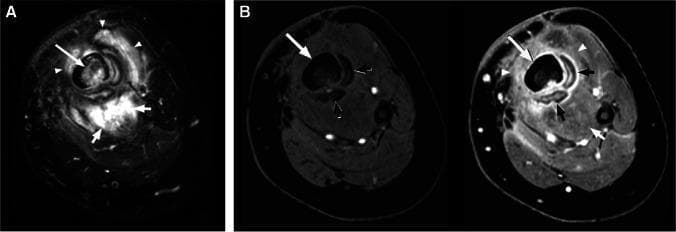 This diagnostic image set consists of axial MR images of the lower leg from a 4-year-old male, illustrating classic features of chronic osteomyelitis: involucrum and sequestrum. Image (A) is an axial T2-weighted fat-suppressed MRI demonstrating diffuse, high-signal intensity (edema) within the tibial medullary canal and the surrounding musculature. Image (B) shows side-by-side axial T1-weighted fat-suppressed images, pre-contrast (left) and post-contrast (right). The primary pathology shows a central, non-enhancing necrotic bone segment (sequestrum) indicated by a long white arrow. Surrounding this is a peripheral shell of new, enhancing bone formation (involucrum), highlighted by short black arrows. The surrounding soft tissues exhibit extensive enhancement and edema (arrowheads and short white arrows), consistent with myositis. These findings are pedagogically significant for distinguishing between viable inflammatory tissue (involucrum, myositis) and non-viable necrotic bone (sequestrum) in pediatric musculoskeletal infections. Target concepts include radiological identification of chronic infection markers and differentiate enhancement patterns in osteomyelitis.