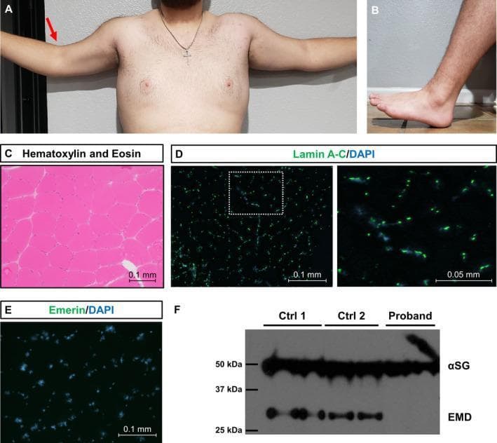 This composite image details the clinicopathological findings of X-linked Emery-Dreifuss muscular dystrophy (EDMD1). Panels A and B are clinical photographs showing physical manifestations: (A) illustrates restricted elbow extension due to contractures (indicated by a red arrow), and (B) shows limited ankle dorsiflexion, indicative of an Achilles tendon contracture. Panel C presents a muscle biopsy (vastus lateralis) with hematoxylin and eosin (H&E) staining, displaying general muscle morphology. Panels D and E are immunofluorescence microscopy images comparing protein expression; (D) shows normal nuclear localization of lamin A/C (green) co-localizing with DAPI (blue), while (E) demonstrates a complete absence of emerin staining in the proband’s nuclei. Panel F is a western blot confirming these results, showing a 34 kDa emerin (EMD) band in two control samples that is absent in the proband's lysate, while the 50 kDa alpha-sarcoglycan (αSG) loading control remains consistent across all samples. These findings collectively characterize the classic triad of EDMD: early-onset contractures, progressive muscle weakness, and emerin protein deficiency.
