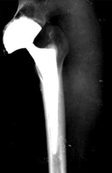 This diagnostic image is an anteroposterior (AP) X-ray radiograph of a human right hip following total hip arthroplasty (THA). The image demonstrates a well-positioned dual-mobility prosthesis. Key components include a radiopaque femoral stem securely seated within the medullary canal of the proximal femur and a large, hemispherical acetabular cup articulated with the femoral head. The femoral stem shows good cortical contact and integration. The acetabular component is appropriately inclined and positioned within the native acetabulum. Bony landmarks such as the greater trochanter and the pelvic rim appear stable, with no visible evidence of periprosthetic fracture, osteolysis, or implant loosening. This visual serves as an educational example of postoperative imaging for a dual-mobility hip replacement, frequently utilized in cases with high dislocation risk or muscular laxity to ensure joint stability.