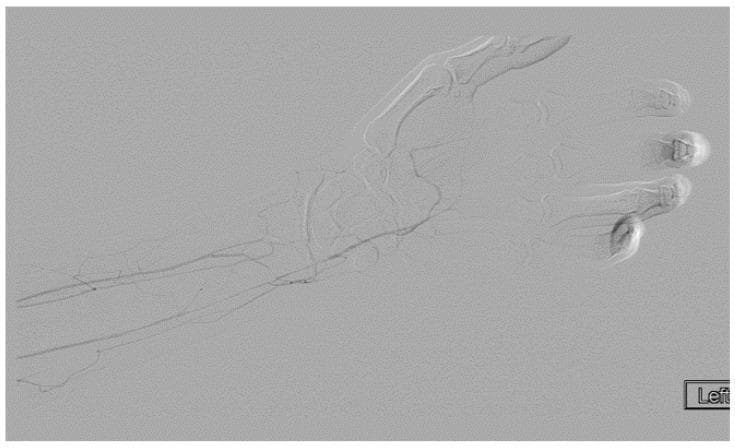 This diagnostic image is a digital subtraction angiogram (DSA) of the left forearm and hand, showcasing the arterial vasculature. The imaging reveals the ulnar artery as the primary source of distal perfusion, extending to form the superficial and deep palmar arches. Notable pathology includes the total occlusion of the radial artery, which is consistent with the patient's history of Arterial Thoracic Outlet Syndrome (ATOS) and distal thromboembolism. The palmar arch shows opacification with contrast leading to the common digital arteries. While there is visible flow to the index, middle, ring, and little fingers via the digital branches, there is a marked absence of contrast opacification in the thumb (princeps pollicis artery), indicating localized ischemia or occlusion. The image demonstrates the clinical consequences of a proximal brachial thrombus causing distal arterial compromise and the importance of assessing collateral flow through the palmar arch in cases of upper extremity arterial disease.