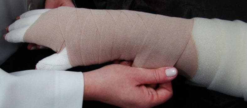 This clinical photograph illustrates the application of multi-layer bandaging (MLB) on the hand and forearm of a patient, a primary intervention for breast cancer-related lymphedema. The image shows a structured approach to compression therapy: an innermost layer of white, soft padding material is applied directly over the fingers, thumb, and arm to protect the skin and ensure even pressure distribution. Overlapping this is a secondary layer consisting of a light brown, short-stretch woven elastic bandage applied in a spiral and figure-eight pattern. This specific arrangement provides high working pressure and low resting pressure, essential for promoting lymphatic drainage and reducing limb volume. The anatomical focus is the upper extremity, demonstrating the complex distal-to-proximal wrapping required to manage interstitial fluid accumulation. This visual serves as an educational tool for physical therapy and oncology nursing regarding Complete Decongestive Therapy (CDT) techniques.