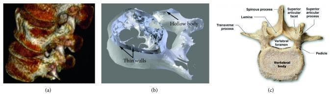 This composite educational image illustrates the transition from radiological data to digital modeling in spinal anatomy. Panel (a) presents a 3D CT reconstruction of the lumbar spine (L3-L5), showing the vertical alignment of vertebral bodies and posterior elements in a lateral view. Panel (b) displays a digital STL (Stereolithography) file of an L5 vertebra, highlighting a hollow internal structure and thin walls, representing a surface-based mesh approximation used in biomedical engineering. Panel (c) is a labeled anatomical diagram of a lumbar vertebra in a superior view. Key landmarks are identified, including the vertebral body, vertebral foramen, pedicle, lamina, spinous process, and transverse processes, as well as the superior articular facet and process. This comparison highlights the structural differences between biological anatomy, volumetric clinical imaging, and surface-based digital models used for 3D printing or surgical planning in orthopedics and regenerative medicine.