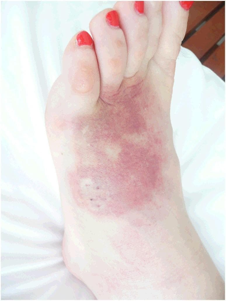 A clinical photograph of the dorsal aspect of a human foot demonstrating significant local envenomation effects following a death adder (Acanthophis species) bite. The image displays a prominent, irregularly shaped area of reddish-purple ecchymosis and bruising covering the midfoot and extending toward the base of the toes. Within this discolored region, several dark punctate lesions or fang marks are visible, consistent with a venomous snakebite. Associated features include localized edema (swelling) and a small, translucent bulla or blister located on the proximal aspect of the second toe. The surrounding skin shows faint, spreading erythema indicative of a local inflammatory response. This visual serves as a primary example of dermatological manifestations of elapid envenomation, highlighting tissue damage, hemorrhage, and localized inflammation which may precede complications such as cellulitis or secondary infection.
