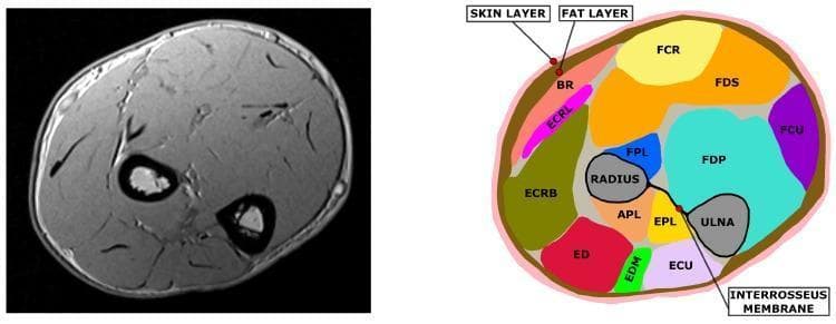 This diagnostic image and anatomical diagram comparison shows a cross-sectional MRI slice of the human forearm (left) alongside its corresponding segmented anatomical map (right). The MRI is a T1-weighted axial scan displaying cortical bone as low-signal (black) voids and muscle bundles as intermediate-signal structures. The segmented diagram identifies key anatomical structures using a color-coding system: the radius and ulna bones are in gray, the interosseous membrane is a black line connecting them, and individual muscles are uniquely colored (e.g., FCR, FDS, FDP, ECU, and ED). The interosseous membrane serves as a landmark dividing the anterior (flexor) and posterior (extensor) muscle compartments. The diagram also illustrates the superficial integumentary layers, with the skin represented in pink and the underlying subcutaneous fat layer in brown. This visual serves as an educational tool for musculoskeletal anatomy, demonstrating the spatial relationships between forearm skeletal structures, deep and superficial muscle groups, and their respective fascial boundaries.
