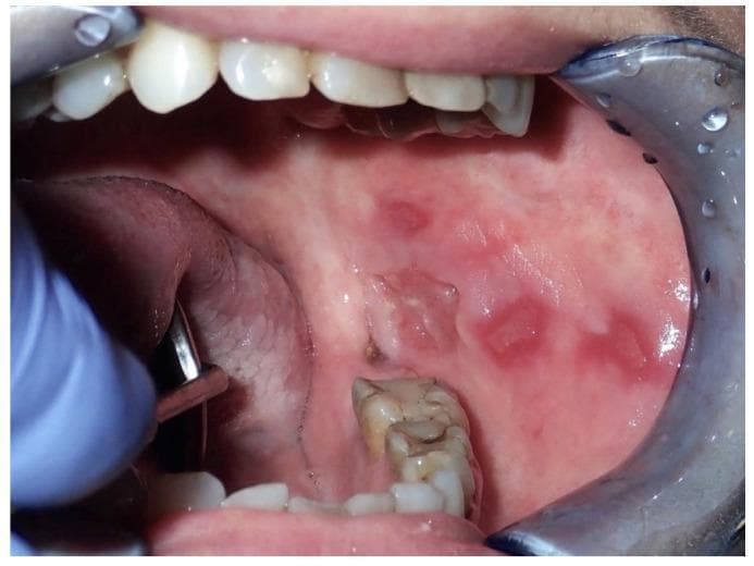 This clinical photograph shows the left buccal mucosa of a 53-year-old female patient, demonstrating multiple multifocal lesions. The visual findings include several well-defined, velvety red patches consistent with erythroplakia, distributed from the posterior to the anterior regions of the cheek. A prominent area of central ulceration is visible, showing a break in the mucosal surface with irregular, slightly raised borders. The surrounding tissue appears mildly edematous. These findings are clinically significant as indicators of potentially malignant disorders, specifically invasive squamous cell carcinoma (OSCC) in this case, which may arise from chronic mucosal trauma. The image illustrates the high-risk nature of erythroplakic and ulcerative oral lesions, highlighting the need for biopsy and histopathological evaluation to distinguish between pre-malignancy and invasive cancer. The target audience includes dental and medical students, as well as oncology specialists focused on early detection of oral cavity malignancies.