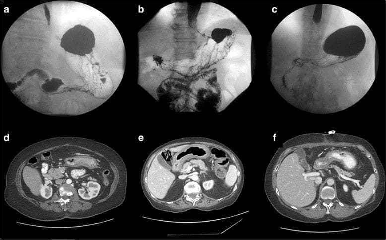 This composite medical image presents diagnostic features of linitis plastica (scirrhous gastric carcinoma) in three different patients using two imaging modalities. The top row (a–c) displays upper gastrointestinal (UGI) contrast studies (barium meals), while the bottom row (d–f) shows corresponding axial computed tomography (CT) scans. In the UGI images, the stomach exhibits characteristic 'leather bottle' morphology, marked by significant loss of distensibility, tubular contraction, and irregular mucosal outlines (especially visible in patient 2). The contrast flow highlights restricted gastric volume and rigid wall structure. The CT scans demonstrate circumferential, diffuse gastric wall thickening across all patients. Patient 1 (d) shows heterogeneous wall thickening, while Patient 2 (e) and Patient 3 (f) exhibit more uniform thickening, with some haziness in the perigastric fat suggesting inflammatory or infiltrative changes. These visual markers illustrate the infiltrative nature of Borrmann type IV tumors, emphasizing the primary pathological features of submucosal and muscularis propria involvement typical of advanced gastric cancer.