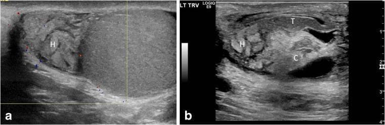 This dual-panel diagnostic image presents longitudinal ultrasound (US) scans of the scrotum, illustrating sonographic markers of testicular torsion. Figure A is a color Doppler US showing an enlarged epididymal head (labeled H) with a swollen, lobular appearance. Notably, there is a complete absence of intrinsic color flow within the epididymal head (avascularity) and decreased intratesticular flow, findings that help differentiate torsion from hyperemic epididymitis. Figure B is a gray-scale US image detailing the epididymal-cord complex. It demonstrates an edematous epididymal head (H) and a tangled, echogenic spermatic cord (C), characteristic of a 'torsion knot' or 'boggy pseudomass.' The epididymal tail (T) remains relatively uninvolved. These images highlight the importance of evaluating the extratesticular structures and the epididymal-cord complex in pediatric patients presenting with acute scrotal pain to diagnose complete or partial testicular torsion, often associated with the 'bell clapper' deformity.