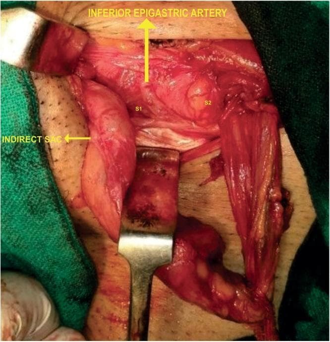 This clinical photograph captures an intraoperative view of an inguinal hernia repair, illustrating complex regional anatomy and multiple hernia sacs. The surgical field displays a rare anatomical variation where the inferior epigastric artery (IEA) follows a superficial course along the posterior wall of the inguinal canal. Two distinct direct inguinal hernia sacs are visible: S1, located lateral to the IEA, and S2, located medial to the IEA. Sac S2 appears larger with a wider base compared to the more elongated S1. Additionally, an indirect hernia sac is identified lateral to the direct components. Surgical retractors are in place to expose the posterior wall and cord structures. This image serves as a high-level educational resource for surgical trainees, demonstrating the critical importance of identifying the inferior epigastric vessels to differentiate between direct and indirect hernia components and to recognize vascular anomalies during Lichtenstein or other inguinal hernioplasty procedures.