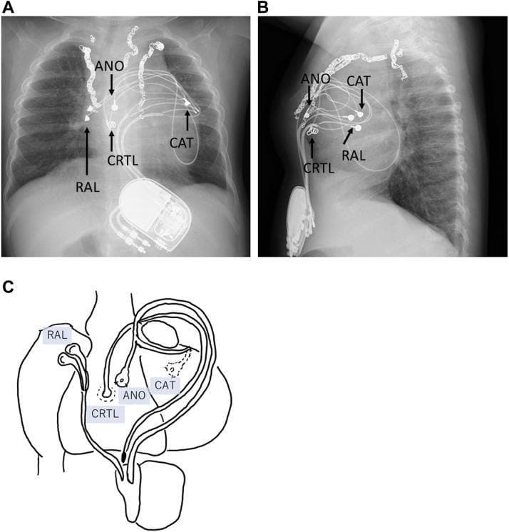 This composite figure includes chest radiographs and a corresponding anatomical diagram illustrating an epicardial pacing system in a pediatric patient. Panel A (anteroposterior view) and Panel B (lateral view) show a radiopaque pacemaker pulse generator implanted in the upper abdominal region, specifically the rectus abdominis muscle sheath. Multiple leads emerge superiorly from the device. Labels indicate the right atrial lead (RAL), the ventricular anode (ANO) positioned on the anterior right ventricular wall, and the ventricular cathode (CAT) placed on the posterior left ventricular wall. A fourth lead (CRTL), intended for cardiac resynchronization therapy, is also visible on the anterior right ventricle. Panel C provides a simplified schematic diagram of the heart, detailing the epicardial attachment sites of these four leads. The radiographs additionally show surgical sternal wires and complex lead loops, which are characteristic of pediatric epicardial systems designed to accommodate growth. This educational visual demonstrates a complex pacing configuration for treating heart failure and left bundle branch block (LBBB) via cardiac resynchronization.