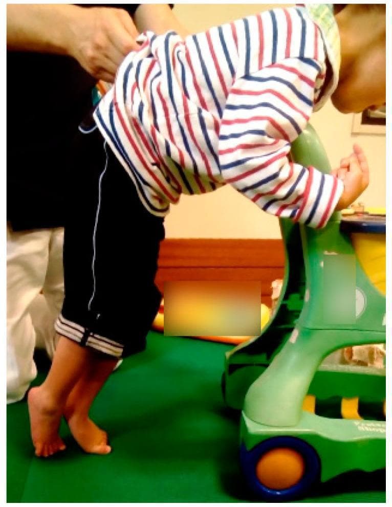 This clinical photograph displays a four-year-old child with spastic cerebral palsy demonstrating a characteristic standing posture while supported by a standing frame and manual assistance. The lower extremities exhibit a classic 'scissors gait' or scissors posture, characterized by hip adduction and internal rotation, causing the legs to cross. The feet are held in a marked equinus position (toe-walking), with the heels significantly elevated off the ground and weight borne on the forefoot. The child shows a forward-leaning trunk posture, utilizing the upper extremities for weight-bearing and balance on a mobility device. This visual illustrates spasticity and motor impairment consistent with Gross Motor Function Classification System (GMFCS) Level IV. The image is an educational example of pediatric neuromotor dysfunction, specifically demonstrating the compensatory postural adaptations and lower limb deformities associated with spastic diplegia.