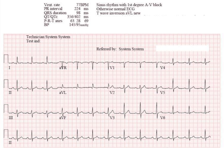 A standard 12-lead electrocardiogram (ECG) printed on red-grid paper, demonstrating a normal sinus rhythm following cardioversion. The diagnostic header indicates a ventricular rate of 77 BPM and a blood pressure of 145/95 mmHg. Key waveform findings include a prolonged PR interval of 224 ms, diagnostic of a first-degree atrioventricular (AV) block. The QRS complex duration is within normal limits at 98 ms, and the QT/QTc intervals are measured at 356/402 ms. Morphologically, P waves are present and consistent across leads, followed by narrow QRS complexes. A notable finding is T-wave inversion in lead aVL. The P-R-T axes are reported at 63, 28, and 69 degrees, respectively. The tracing includes limb leads (I, II, III, aVR, aVL, aVF) and precordial leads (V1-V6), with a continuous rhythm strip of lead II at the bottom. This image serves as a clinical example of post-cardioversion rhythm assessment and the presentation of a first-degree heart block.