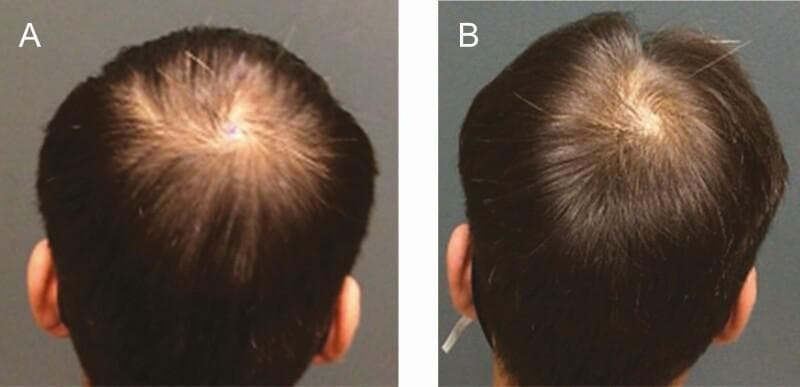 Clinical photograph comparison (before and after) depicting androgenetic alopecia treatment outcomes in a 27-year-old male. Image A (pre-treatment) shows the vertex of the scalp with characteristic patterned hair loss consistent with Norwood-Hamilton Stage III. There is visible thinning and miniaturization of hair follicles, leading to increased scalp exposure and reduced hair density in the central crown area. Image B (one-year post-treatment) demonstrates a significant increase in hair density and thickness following the administration of extracellular vesicle-based therapy (Exoflo). The central scalp region shows improved coverage with more robust, pigmented terminal hairs, resulting in a marked reduction in visible scalp surface. This comparison serves as a clinical illustration of therapeutic response in regenerative medicine for hair restoration, highlighting the transition from sparse hair distribution to denser scalp coverage.