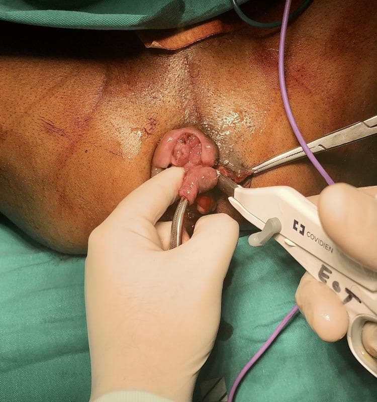 This clinical photograph captures an intraoperative view of a hemorrhoidectomy being performed in a colorectal surgical setting. The surgical field focuses on the perianal region, where a prolapsed, edematous hemorrhoidal mass is visible. The surgeon is employing a bipolar electrosurgical vessel-sealing device (LigaSure, Covidien) to excise the hemorrhoidal tissue while simultaneously achieving hemostasis through thermal fusion of the vascular pedicle. Artery forceps are used to provide traction and stabilize the tissue, allowing for precise dissection at the mucocutaneous junction. The photograph demonstrates the application of energy-based surgical instruments in proctology for reducing blood loss and operative time compared to traditional diathermy or excisional techniques. Key anatomical features include the external anal sphincter area and the diseased vascular cushions of the anal canal. The image is intended for medical education regarding modern surgical management of Grade III or IV hemorrhoids.