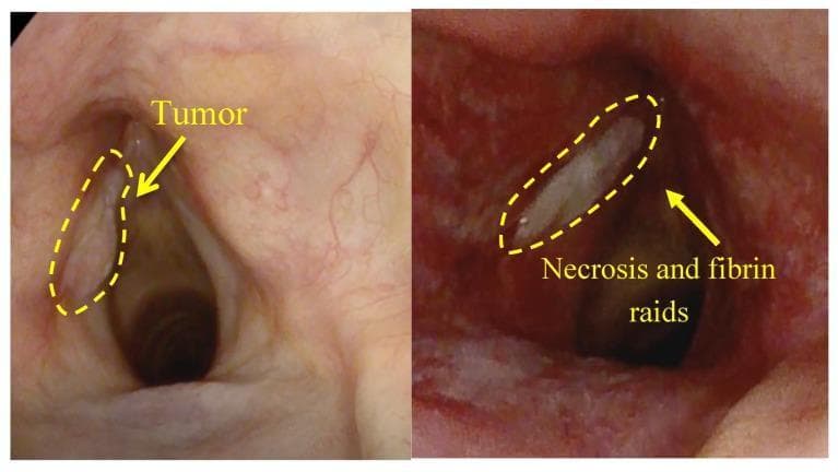 A side-by-side comparison chart featuring two endoscopic views of the larynx, specifically the vocal cords, demonstrating the effects of Photodynamic Therapy (PDT) on squamous cell carcinoma. The left image (pre-treatment) shows a protruding, off-white mass on the left vocal cord, demarcated by a yellow dashed oval and labeled 'Tumor'; the surrounding laryngeal mucosa appears pink with healthy vascularization. The right image (post-treatment, 7 days later) displays the same anatomical region showing significant inflammatory changes with deep red, hyperemic tissue. A yellow dashed oval highlights a localized area of 'Necrosis and fibrin raids,' appearing as a thick, whitish-gray plaque replacing the previous tumor site. This comparison illustrates the transition from a malignant neoplasm to therapeutic tissue destruction and necrosis. The images are relevant for oncology and otolaryngology, specifically for assessing treatment efficacy and the natural progression of tissue healing following PDT for laryngeal cancer.