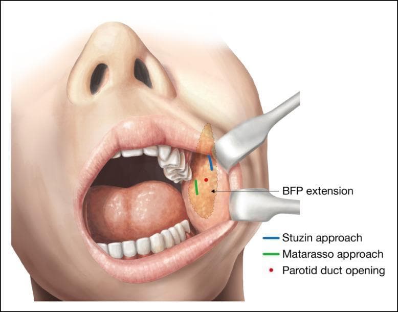 This medical anatomical diagram illustrates the surgical approaches for buccal fat pad (BFP) excision from an intraoral perspective. The diagram depicts an open mouth with surgical retractors exposing the buccal mucosa of the left cheek. Key anatomical landmarks include the parotid duct opening (Stensen's duct), marked by a red dot. The BFP extension is visualized as a shaded yellow oval within the cheek tissue. Two distinct surgical entry points are highlighted: 1) The Stuzin approach, indicated by a blue line, showing a superior incision in the maxillary gingivobuccal sulcus above the parotid duct to directly access the BFP pocket. 2) The Matarasso approach, indicated by a green line, showing an inferior incision in the oral vestibule approximately 1 cm below the parotid duct exit. This illustration serves as an educational guide for plastic surgery and maxillofacial procedures, emphasizing the spatial relationship between surgical incisions, the buccal fat pad, and critical structures like the parotid duct to minimize risk of glandular injury during facial contouring.