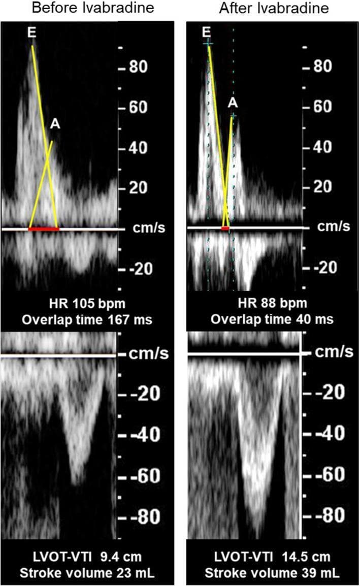 A comparison chart consisting of four echocardiographic images (spectral Doppler) demonstrating hemodynamic changes before and after the administration of ivabradine in a patient with heart failure. The left column shows baseline parameters at a heart rate (HR) of 105 bpm, featuring severe tachycardia-induced overlap (167 ms) between the mitral inflow E-wave (early diastole) and A-wave (atrial contraction), along with a low left ventricular outflow tract velocity-time integral (LVOT-VTI) of 9.4 cm and stroke volume (SV) of 23 mL. The right column illustrates the response to ivabradine, showing a reduced HR of 88 bpm. Visually, this reduction in heart rate leads to a significant decrease in E-A wave overlap (to 40 ms), allowing for improved diastolic filling time. Consequently, there is a notable increase in systolic performance markers, with LVOT-VTI rising to 14.5 cm and stroke volume increasing to 39 mL. This diagnostic image set highlights the pharmacological benefit of selective heart rate reduction in optimizing ventricular-arterial coupling and stroke volume via the Frank-Starling mechanism.