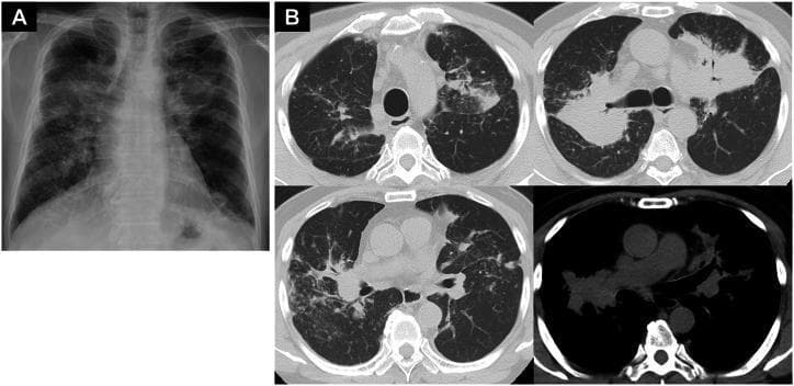 This composite diagnostic image features a posterior-anterior (PA) chest X-ray and axial chest computed tomography (CT) scans illustrating systemic sarcoidosis. (A) The chest X-ray shows bilateral, ill-defined hilar and mid-zone opacities, consistent with lymphadenopathy and pulmonary parenchymal involvement. (B) The CT scans (lung and mediastinal windows) provide detailed views of extensive mediastinal and bilateral hilar lymphadenopathy. Significant parenchymal findings include bilateral tumor-like consolidations and diffuse micronodular (granular) shadows with a perilymphatic distribution, characteristic of Stage II or III pulmonary sarcoidosis. Some lesions appear as large, dense masses mimicking malignancy, while others are small and scattered. The mediastinal window specifically highlights the conglomerate enlargement of the paratracheal and subcarinal lymph nodes. These findings, in conjunction with elevated ACE and sIL-2R levels mentioned in clinical context, demonstrate the multisystemic nature of the disease and its potential for varied radiological manifestations.