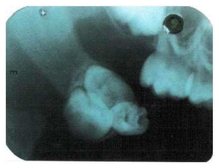 This diagnostic image is an intraoral periapical radiograph demonstrating a compound odontoma. The primary focus is a cluster of three distinct, radiopaque tooth-like masses (denticles) of varying ovoid and irregular shapes, mimicking the morphology of miniature teeth. These radiopaque structures are well-defined and grouped closely together. Encircling the entire mass is a thin, uniform radiolucent rim, which represents the follicular space or fibrous capsule of the lesion. The lesion is situated within the soft tissues, specifically described in clinical context as the posterior aspect of the buccal mucosa, showing a lack of direct attachment to the alveolar bone or adjacent primary dentition visible in the periphery. This radiographic presentation is a classic hallmark of a compound odontoma, an odontogenic hamartoma composed of organized dental tissues (enamel, dentin, and pulp). The image serves as an educational example for oral and maxillofacial pathology, illustrating the diagnostic differentiation between compound and complex odontomas based on morphological organization.
