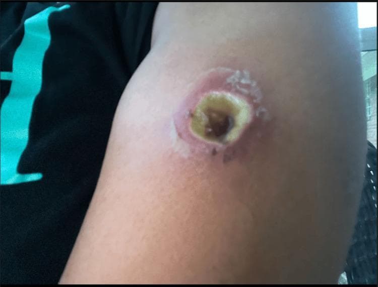 This clinical photograph displays a focal, well-demarcated skin lesion on the left upper extremity, characteristic of cutaneous loxoscelism (brown recluse spider bite). The wound exhibits a central necrotic core, appearing as a dark brown to black eschar, indicative of tissue infarction. This is immediately surrounded by a ring of yellowish, fibrinous slough and pale tissue, suggesting liquefactive necrosis or secondary infection. The periphery of the lesion shows a prominent concentric band of erythema, signaling intense localized inflammation and possible cellulitis. Evidence of epidermal sloughing and desquamation is visible at the margins of the inflammatory ring. Clinically, this sequence represents the 'red, white, and blue' sign often associated with recluse bites, where central necrosis (blue/black) is bordered by pallor (white) and extensive erythema (red). The image demonstrates the progression of dermal necrosis and the inflammatory response typical of venom-induced tissue damage.