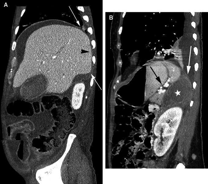 Two sagittal CT images demonstrating the anatomy and pathways of the extraperitoneal spaces in the upper abdomen. Image A shows the right upper quadrant where peritoneal fluid surrounds most of the liver. White arrows indicate the superior and inferior peritoneal reflections. The area posterior and medial to these reflections, known as the 'bare area' of the liver (black arrowhead), is devoid of peritoneum and directly abuts the diaphragm. Image B illustrates the left side, showing a hypodense fluid collection (asterisk) within the left perinephric space. This collection extends superiorly to contact the diaphragm (white arrow) and is positioned posterior to the pancreas (P) and the splenorenal ligament (black arrow). These images are pedagogically used to highlight how anatomical boundaries like the bare area and renal fascia determine the spread of intraperitoneal versus extraperitoneal fluid or disease.