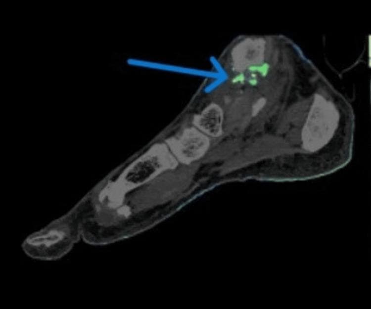 This diagnostic image is a sagittal reconstruction of a Dual-Energy Computed Tomography (DECT) scan of the right foot. The image serves as a specific modality for the non-invasive detection of gout by identifying monosodium urate (MSU) crystals. High-density anatomical structures, including the calcaneus, talus, and metatarsals, are visualized in traditional grayscale. Superimposed on the grayscale CT image are color-coded green voxels, which represent the presence and distribution of uric acid deposits. A prominent blue arrow indicates the primary site of deposition located at the superior aspect of the foot, specifically corresponding to the region of the deltoid and posterior talofibular ligaments near the ankle joint. This visualization demonstrates periarticular MSU crystal accumulation, a hallmark of chronic tophaceous gout, allowing for differentiation from other inflammatory arthropathies like rheumatoid arthritis. The educational focus is on the clinical utility of DECT in identifying specific chemical compositions in soft tissues and ligaments based on varied X-ray absorption properties.
