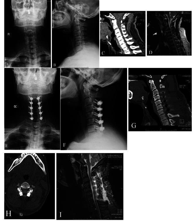 This composite of clinical images illustrates the preoperative and postoperative findings of a patient with multilevel cervical stenotic myelopathy (MCSM) treated via posterior cervical laminectomy and fusion (PCLF). The top row (A–D) displays preoperative state: (A, B) anterior-posterior and lateral X-rays showing cervical alignment; (C, D) sagittal CT and T2-weighted MRI highlighting cervical stenosis and spinal cord compression from C3 to C7 due to osteophytes. The middle and bottom rows (E–I) show postoperative results: (E, F) X-rays demonstrating bilateral lateral mass screw fixation and rods spanning C3–C7; (G) sagittal CT reconstruction and (H) axial CT slice confirming the laminectomy and the precise placement of screws within the lateral masses; and (I) sagittal T2-weighted MRI revealing successful decompression of the cervical spinal cord with increased subarachnoid space and resolution of stenosis. This educational material compares different imaging modalities (X-ray, CT, MRI) to evaluate surgical outcomes in spinal instrumentation and decompression.