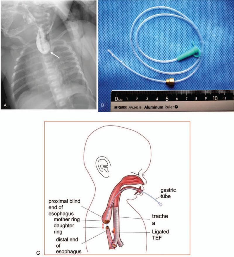 This composite figure illustrates the diagnosis and innovative surgical management of long-gap esophageal atresia (LGEA) with tracheoesophageal fistula (TEF). Panel A is an anteroposterior chest radiograph of a neonate featuring a contrast-filled, dilated proximal esophageal blind pouch terminating at the T2 vertebral level (indicated by a white arrow), a classic radiographic finding for esophageal atresia. Panel B is a clinical photograph showing the customized magnetic compression anastomosis (MCA) device, consisting of a larger 'mother ring' (7mm) and a smaller 'daughter ring' (5mm) threaded onto a gastric tube. Panel C provides a schematic diagram of the surgical approach: the mother ring is positioned in the proximal blind pouch and the daughter ring in the distal esophageal segment. The diagram highlights the use of a 6F gastric tube passing through the central holes of both rings to facilitate alignment and magnetic attraction. Anatomical labels identify the trachea and a ligated TEF. This visual set demonstrates the application of magnetic force to approximate esophageal ends for non-manual anastomosis in complex congenital anomalies.