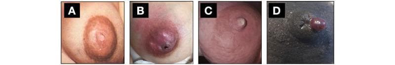 This clinical photograph set displays four distinct pathological conditions of the human breast and nipple in lactating patients across various skin tones. Panel A demonstrates breast engorgement featuring an inverted nipple with a light-colored central depression and taut, shiny skin. Panel B shows a breast abscess characterized by significant periareolar erythema, localized swelling, and a dark necrotic-appearing lesion at the nipple-areolar complex suggestive of nipple damage or a draining sinus. Panel C illustrates granulomatous mastitis with visible skin wrinkling, nipple inversion, and generalized breast inflammation. Panel D depicts acute nipple damage on dark-pigmented skin, highlighted by a prominent, raised, fluid-filled blood blister (hemorrhagic bleb) located on the lateral aspect of the nipple. This series serves as an educational comparison for differentiating mastitis, abscess, engorgement, and mechanical nipple trauma, while highlighting common visual pitfalls that can lead to clinical misclassification.