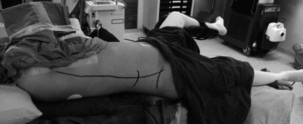 A clinical photograph in grayscale illustrating the 'Giusti position' for supine percutaneous nephrolithotomy (PCNL). The patient is positioned supine with a 15-20 degree rotation toward the contralateral side, supported by padding under the scapula and buttocks to expose the flank. The ipsilateral leg (same side as the stone) is extended and kept straight, while the contralateral leg is abducted and flexed in a cystoscopy or lithotomy position to facilitate simultaneous retrograde endourological access. On the exposed flank, dark surgical skin markings indicate critical anatomical landmarks for renal access, including the posterior axillary line, the lower rib margin, and the iliac crest. This surgical setup is designed for endourological procedures like PCNL, allowing for improved spontaneous fragment passage and ease of simultaneous ureteroscopy or retrograde contrast studies without the need for patient repositioning.