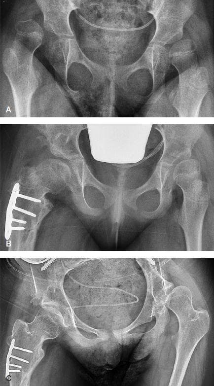 A series of three anteroposterior pelvic radiographs (A, B, C) documenting the longitudinal management of hip dysplasia in a pediatric patient with Gross Motor Function Classification System (GMFCS) level V cerebral palsy. Radiograph A (baseline) shows complete lateral and superior dislocation of the right hip with a high migration percentage (MP 100%) and subluxation of the left hip (MP 51%). Radiograph B, taken 14 months post-surgical intervention, displays the results of a right femoral varus osteotomy and pelvic Dega osteotomy. Visible hardware includes a lateral femoral compression plate secured with five screws. Both hips show improved containment with mild residual subluxation. Radiograph C, at 7.3 years follow-up, demonstrates a well-seated right hip joint with stable surgical hardware and remodeled femoral neck-shaft angle. In contrast, the untreated left hip shows significant progression of subluxation (MP 64%) with flattening of the acetabular roof and lateralization of the femoral head, illustrating the natural history of hip displacement in non-ambulatory patients without prophylactic bony surgery.