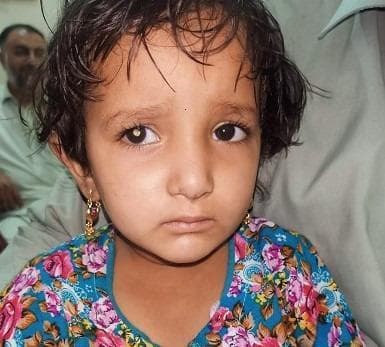 This clinical photograph displays a 5-year-old female child exhibiting a classic hallmark sign of intraocular pathology. The primary finding is leukocoria, or a 'white reflex,' visible in the patient's right eye. While the left eye demonstrates a normal dark pupillary reflex, the right pupil shows a distinct yellowish-white opacification instead of the normal red reflex. This visual phenomenon is highly characteristic of retinoblastoma, the most common primary intraocular malignancy of childhood. The image serves as an educational tool for ophthalmology and pediatrics, emphasizing the importance of recognizing abnormal pupillary reflexes during routine physical examinations. Early detection of leukocoria is critical for the diagnosis of potentially life-threatening and sight-threatening conditions, including retinoblastoma, Coats' disease, or congenital cataracts. The photograph illustrates the typical presentation where a parent or clinician might first notice the abnormality in dim lighting or via flash photography.