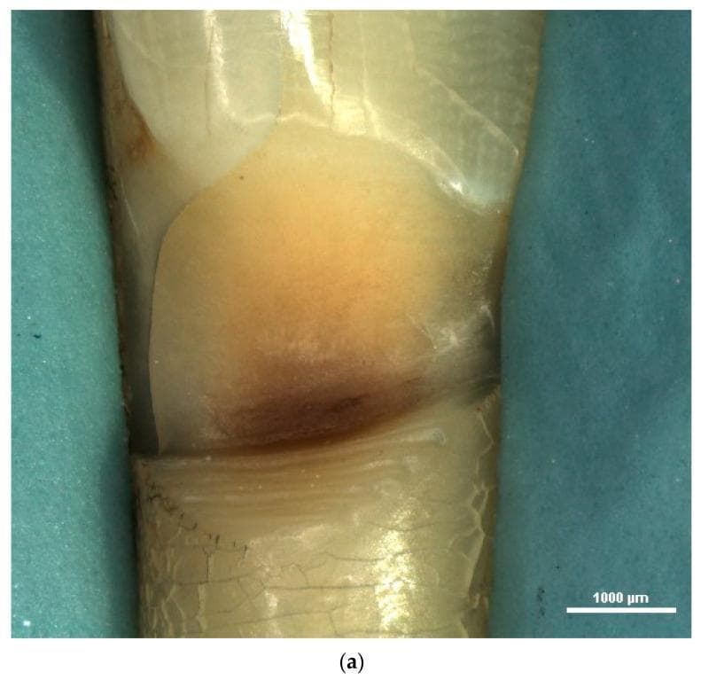 This stereomicroscopic diagnostic image (15x magnification) displays a clinical view of a human lower incisor affected by a prominent Non-Carious Cervical Lesion (NCCL). The lesion is located at the cervical margin, exhibiting a characteristic wedge-shaped morphology with a sharp internal angle. There is significant loss of hard dental tissue, with the lesion floor demonstrating exposed dentin and a dark brownish discoloration indicative of chronic mineral loss or extrinsic staining. Micromorphological features include a rough, irregular surface texture marked by visible furrows, cracks, and scratches. The adjacent enamel appears relatively intact, though fine crazing lines are visible on the tooth surface surrounding the defect. This image illustrates the macromorphological impact of mechanical or chemical wear—such as abfraction, abrasion, or erosion—on the dental hard tissues at the cementoenamel junction, serving as a primary educational example of wedge-shaped NCCLs for dental professionals and students.