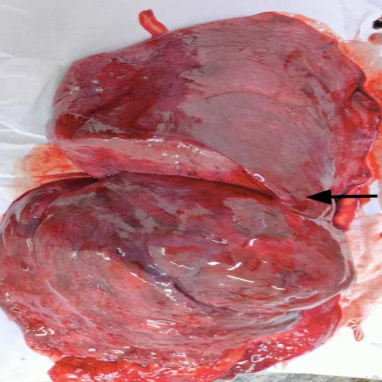 This clinical photograph shows a gross anatomical specimen of a right human lung, focusing on its lateral aspect. The lung exhibits a deep reddish-purple coloration and a moist, glistening pleural surface, characteristic of a fresh cadaveric or surgically resected specimen. A black arrow identifies an incomplete horizontal fissure. Rather than completely separating the superior lobe from the middle lobe, the fissure appears as a shallow, abbreviated groove that terminates before reaching the anterior border of the lung. This anatomical variation demonstrates partial fusion between the superior and middle lobes. The oblique fissure is also partially visible, separating the inferior lobe from the rest of the lung parenchyma. This image is used in medical education to illustrate normal anatomical variations in lung lobar anatomy and the clinical significance of fissure completeness for procedures such as lobectomies and pulmonary segmentectomies.