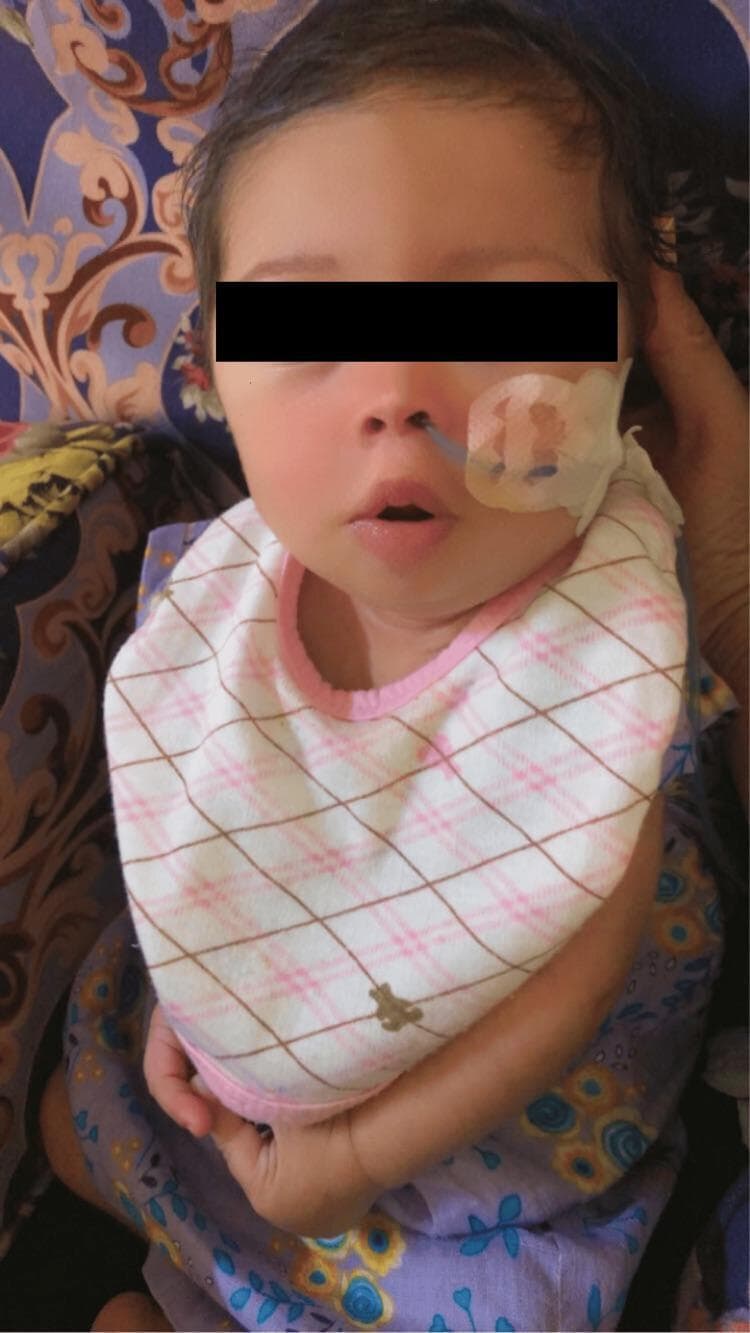 Clinical photograph of an infant diagnosed with Down syndrome (Trisomy 21), demonstrating typical facial features and supportive medical intervention. The infant presents with a flat facial profile, small nose, and an open-mouth posture, which are common dysmorphic features associated with the condition. A nasogastric (NG) tube is visible, entering through the right nostril and secured to the right cheek with a translucent adhesive dressing. The NG tube is indicated for nutritional support due to feeding difficulties often encountered in pediatric patients with genetic syndromes or hypotonia. The image illustrates the practical management of neonatal feeding challenges and the physical phenotype of Down syndrome. The patient is shown in a domestic or clinical setting wearing floral clothing and a bib, with eyes obscured for privacy in a medical publication context.