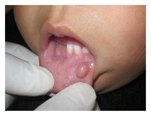 A close-up clinical photograph of an infant's oral cavity showing a mucocele on the lower lip mucosa. The image demonstrates a well-circumscribed, sessile, and roughly spherical nodule approximately 5 mm in diameter. The lesion is located on the labial mucosa of the lower lip and exhibits a smooth, translucent surface with a color similar to or slightly more pale than the surrounding pink mucosa. A gloved hand is visible, gently everting the lower lip to provide clear visualization of the pathology. The upper primary incisors are visible in the background. This clinical presentation is classic for a mucous extravasation cyst (mucocele), typically caused by local trauma or blockage of minor salivary gland ducts. The image serves as an educational example of common pediatric oral soft tissue lesions and their clinical morphology.