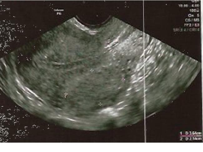 Diagnostic Image: This transvaginal ultrasound (TVUS) scan demonstrates a uterine leiomyoma (fibroid) following treatment with ulipristal acetate (UPA). The fibroid appears as a well-circumscribed, heterogeneous mass within the myometrium, exhibiting mixed echogenicity with interspersed hypoechoic areas and small anechoic cystic components, which may represent focal degeneration. The endometrium is visualized as a distinct, thin, echogenic linear structure adjacent to the mass, maintaining a regular proliferative appearance without significant distortion or displacement by the fibroid. Caliper markings are present on the image for size measurement. This clinical photograph is used in gynecology to monitor the response of uterine fibroids to medical management, focusing on volume reduction and the assessment of endometrial changes.