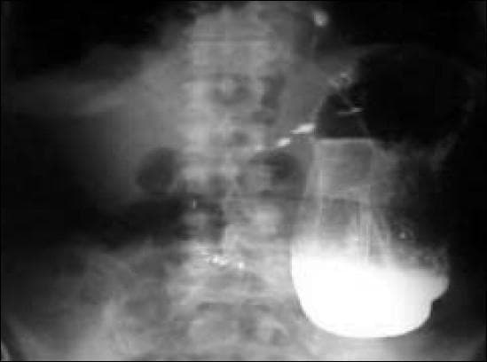 This diagnostic image is a barium meal abdominal X-ray (fluoroscopy) demonstrating a hugely dilated stomach and gastrointestinal malposition. The stomach is massively distended, extending inferiorly toward the level of the pelvis. A characteristic 'beaked' appearance is visible at the pylorus, which is highly suggestive of a gastric outlet obstruction secondary to organoaxial torsion or volvulus. Superiorly, the image reveals colonic loops that have herniated into the thoracic cavity through a large diaphragmatic or hiatal defect. This clinical photograph illustrates the radiological features of a complicated hiatal hernia and associated gastric volvulus post-reduction attempt. The image is a primary educational tool for identifying abnormal contrast distribution in the upper GI tract, secondary manifestations of obstructive gastric volvulus, and the identification of intrathoracic abdominal viscera. Key landmarks include the vertebral column for orientation, the radiopaque contrast pool in the dependent portion of the dilated stomach, and the presence of gas-filled bowel shadows within the chest region.