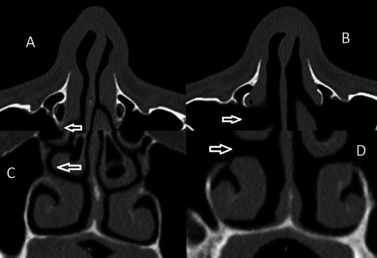 This diagnostic imaging set consists of four paranasal sinus Computed Tomography (CT) scans comparing preoperative and postoperative states following pyriform turbinoplasty (PT) and lateral nasal wall lateralization (LNWL). Panel A (axial) and Panel C (coronal) show the preoperative baseline, where the inferior turbinates (IT) contribute to a relatively narrow nasal airway. White arrows point to the IT position. Panel B (axial) and Panel D (coronal) display the postoperative results, characterized by a significant widening of the nasal cavity. The visual evidence shows the inferior turbinates have been lateralized, increasing the cross-sectional area of the nasal airway and the space between the nasal septum and the lateral nasal wall. The images illustrate the structural changes in the lateral nasal wall and the repositioning of the IT 'shoulder' to alleviate nasal obstruction. This comparison serves as an educational example for otolaryngologists and radiology students to visualize the surgical outcomes of functional nasal procedures on paranasal sinus anatomy.