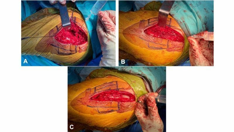 A series of three clinical photographs (A-C) demonstrating the intraoperative steps of peri-articular multimodal drug injection (PMDI) during hip arthroplasty. All images show a lateral approach to the hip with the skin prepped in a sterile yellow antiseptic solution and marked with surgical ink. Figure A illustrates the deep injection into the hip capsule; a metallic retractor reflects the gluteus muscles to expose the joint space while a syringe delivers the analgesic cocktail. Figure B shows the second stage of injection into the gluteus medius muscle and tensor fascia lata after prosthesis insertion and muscle repair, with a retractor maintaining surgical access to the red, fleshy muscle tissue. Figure C depicts the final stage where the solution is injected into the subcutaneous tissue layer before skin closure, with the incision site partially apposed. This sequence serves as an educational guide for orthopedic surgeons on the standardized anatomical layers for local infiltration analgesia to optimize postoperative pain management.