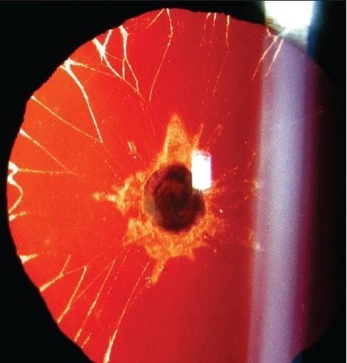 This slit-lamp photograph shows the anterior segment of a human eye using retroillumination through a dilated pupil. The image demonstrates a congenital lens opacity, specifically a plaque-like anterior polar cataract. Centrally, there is a dense, dark axial opacity surrounded by a fuzzy, irregular, whitish halo. Radiating from this central lesion toward the lens periphery are multiple fine, linear, whitish lines resembling a spiderweb or 'cracked' pattern, which are characteristic of persistent pupillary membrane remnants or epicapsular stars. The red reflex in the background provides high contrast, highlighting the morphology and distribution of these opacities. This visual illustrates clinical signs often associated with embryological developmental abnormalities of the lens vesicle or pupillary membrane regression, relevant in pediatric ophthalmology for diagnosing infantile cataracts and associated anterior segment dysgenesis.