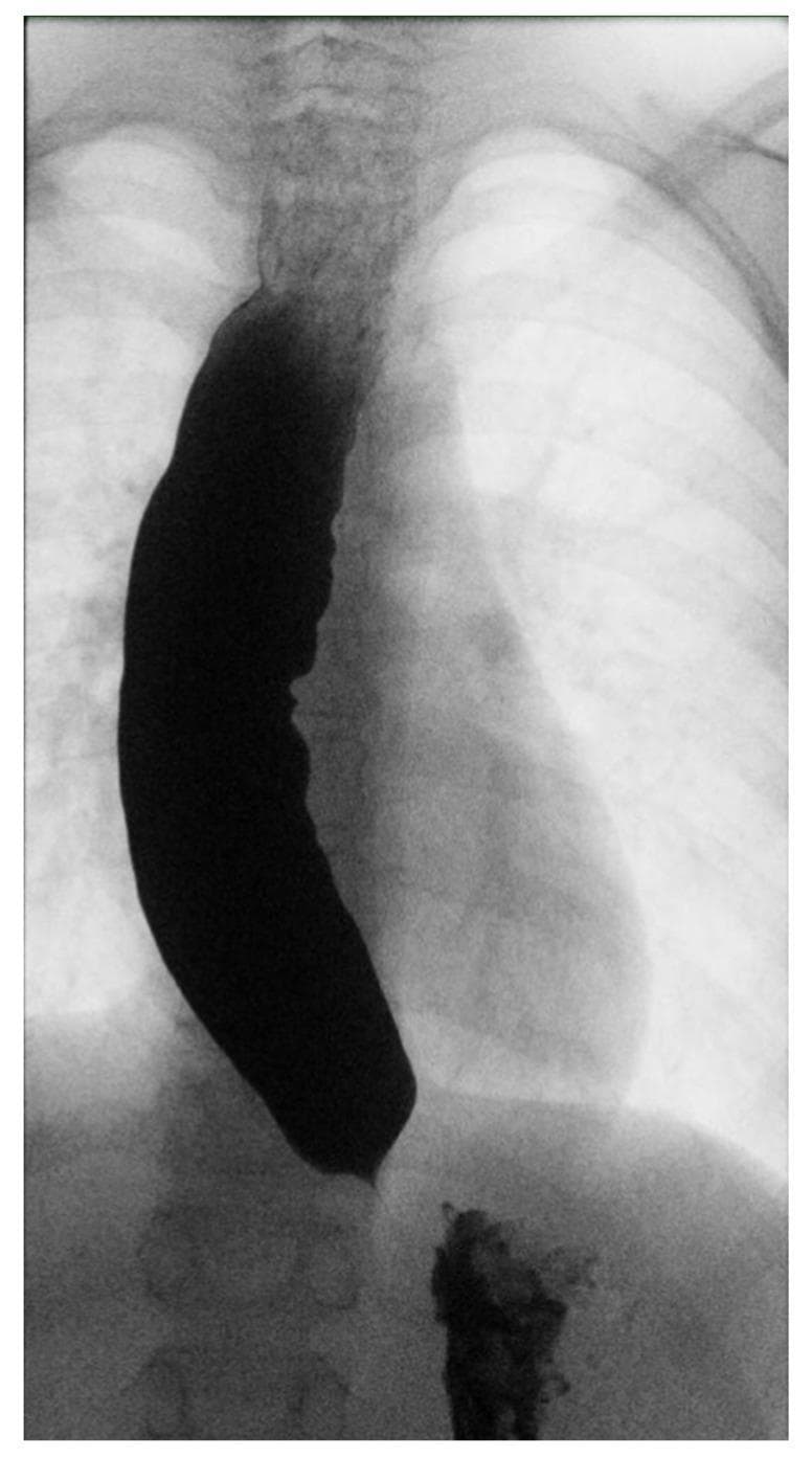 Diagnostic barium swallow radiograph (esophagogram) of the chest and upper abdomen demonstrating classic radiographic features of achalasia. The primary finding is a markedly dilated and tortuous esophagus, which is opacified by a thick column of barium contrast. The esophageal body shows significant proximal expansion with irregular, undulating contours. Distally, the esophagus tapers sharply at the gastroesophageal junction, creating a pathognomonic 'bird's beak' appearance, indicative of a failure of the lower esophageal sphincter (LES) to relax. There is significant stasis of contrast material within the esophageal lumen, with only a minimal, trickle amount of barium observed passing into the stomach. The image illustrates impaired esophageal motility and delayed emptying, which are key clinical hallmarks of esophageal achalasia. This imaging is essential for students and clinicians studying swallowing disorders and motility pathologies in gastroenterology.