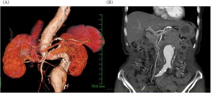 This diagnostic image provides a preoperative evaluation of an abdominal aortic aneurysm (AAA) using Computed Tomography (CT). Panel A shows a 3D volume-rendered CT reconstruction highlighting the vascular anatomy in a color-enhanced format. It clearly depicts the abdominal aorta, bilateral renal arteries, and both kidneys, with a focal aneurysmal dilation measuring approximately 47 mm located infrarenally. Panel B is a coronal CT scan with contrast enhancement, demonstrating the cross-sectional morphology of the infrarenal aortic aneurysm. This view reveals a significant intramural thrombus (mural thrombus) represented by a thick, low-attenuation layer along the vessel wall, which contributes to the narrowing of the true lumen and near-occlusion of the lumbar arteries. The relationship between the aneurysm and the renal artery origins is essential for surgical planning, such as endovascular aneurysm repair (EVAR). This imagery serves to teach vascular pathology, specifically the diagnostic features of AAA and the associated risk of spinal cord ischemia due to lumbar artery occlusion.