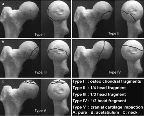 This orthopaedic anatomical diagram illustrates the Chiron classification (2004) for femoral head fractures, shown across five categorized types (Type I to Type V). Each type is presented using a dry bone model of the proximal femur from two perspectives: a lateral/oblique view and a frontal view of the femoral head. Fracture lines are demarcated by solid black lines to indicate the morphology and size of the fracture fragments. Type I displays small osteochondral fragments at the superior-lateral aspect. Type II shows a 1/4 head fragment on the anterior-superior surface. Type III demonstrates a 1/3 head fragment extending from superior to posterior. Type IV depicts a vertical fracture dividing approximately 1/2 of the femoral head. Type V illustrates cranial cartilage impaction with multiple intersecting lines across the superior articular surface. The classification is clinically relevant for orthopedic surgeons and residents for determining the severity of femoral head trauma and informing surgical decisions, such as fragment fixation versus excision based on size and location.