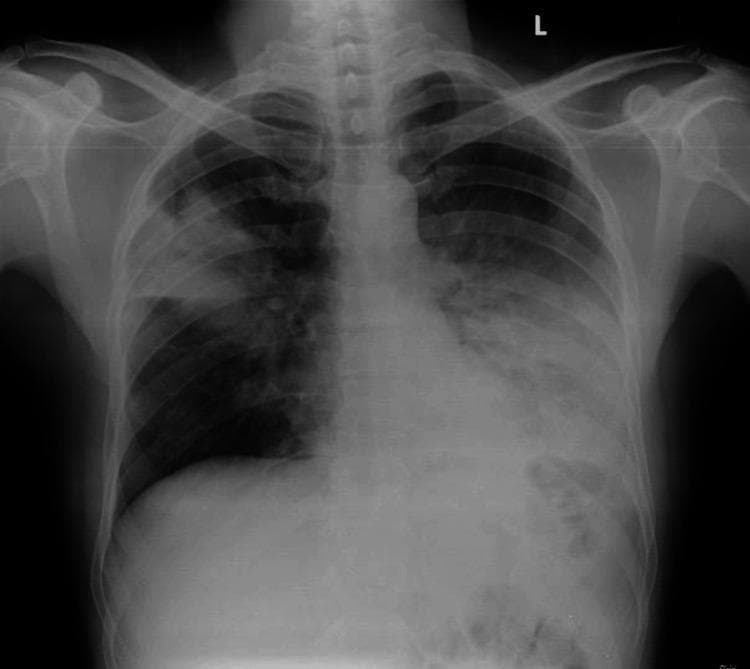 This diagnostic image is a posterior-anterior (PA) chest X-ray demonstrating multifocal pneumonia in a 49-year-old patient. The primary visual findings include significant areas of increased opacity, consistent with consolidation, located in the right upper lobe and the left lower lobe. The right upper lobe consolidation shows a relatively clear inferior margin along the minor fissure. In the left lung, a dense, patchy opacity is visible in the lower zone, obscuring the normal diaphragmatic contour and the left costophrenic angle, characteristic of lower lobe involvement. The heart size appears within normal limits (normal cardiothoracic ratio), and the trachea is midline without deviation. The mediastinal contours are preserved despite the adjacent pulmonary infiltrates. This radiographic presentation is typical for bacterial or community-acquired pneumonia, serving as an educational example of lobar consolidation patterns and the silhouette sign in clinical radiology.