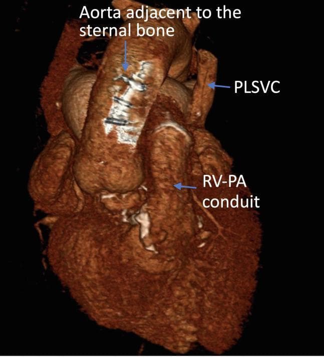 This diagnostic image shows a three-dimensional volume-rendered reconstruction of a computed tomography (CT) scan of the heart and great vessels, highlighting complex cardiovascular anatomy in a preoperative context. The reconstruction demonstrates the aorta's close proximity to the posterior surface of the sternal bone, a critical finding for planning redo sternotomies to avoid catastrophic vascular injury. Key vascular structures are labeled, including a persistent left superior vena cava (PLSVC) located on the anatomical left, and a right ventricle-to-pulmonary artery (RV-PA) conduit, which is visible as a tube-like prosthetic structure connecting the inferior heart chamber to the pulmonary circulation. The image illustrates post-surgical anatomy and congenital variations, specifically targeting advanced cardiothoracic surgical planning. Sternal wires or artifacts are visible on the anterior surface of the aorta where it is adjacent to the bone. This visual resource is used to educate on the spatial relationships in complex adult congenital heart disease and the utility of 3D CT modeling for surgical safety.