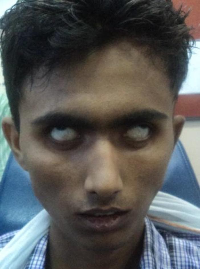 A clinical photograph of a young male patient demonstrating clinical signs of bilateral facial nerve paralysis (Bell's palsy), specifically categorized as House-Brackmann Grade 5 (severe dysfunction). The image highlights a significant lagophthalmos, with a complete inability to close either eyelid voluntarily. The eyes are wide open, and the upward rotation of the eyeballs (Bell's phenomenon) is visible, showing predominantly white sclera. There is a marked loss of facial muscle tone and expression, resulting in a mask-like appearance. The forehead remains smooth with an absence of wrinkling, and there is a lack of nasolabial fold definition bilaterally. This visual demonstrates the severe neurological impact on the muscles of facial expression, including the orbicularis oculi and frontalis muscles, often seen in systemic or bilateral pathologies such as tuberculous otitis media or other severe infectious/inflammatory conditions.